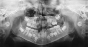 Dental Radiographs (X-Rays) - Pediatric Dentist & Breastfeeding expert in Albany, NY