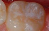 Sealant-After - Pediatric Dentist & Breastfeeding expert in Albany, NY